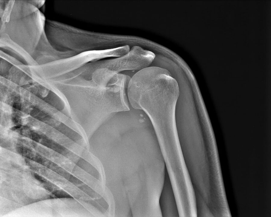 2 sunkumo laipsnio peties sąnario artrozės rentgenograma