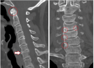 Kompiuterinė tomografija rodo, kad dėl krūtinės ląstos osteochondrozės pažeisti slanksteliai ir įvairaus aukščio diskai. 