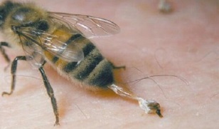 bičių klubo sąnario artrozės gydymas