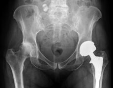 klubo sąnario artrozės diagnozė