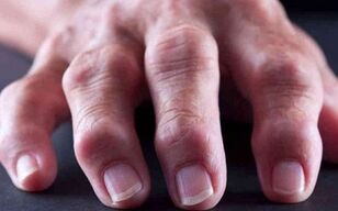 reumatoidinis artritas kaip sąnarių skausmo priežastis